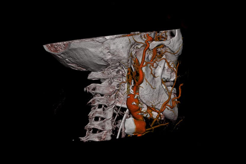 Angiographie - Gefässdarstellung 3D Schädel